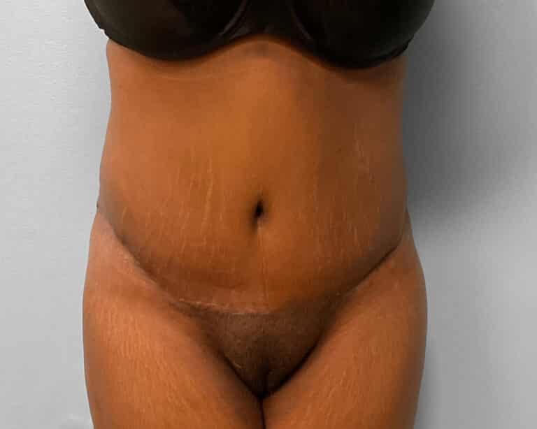 After Image: Tummy Tuck & Lipo – Dr. Tucker - front