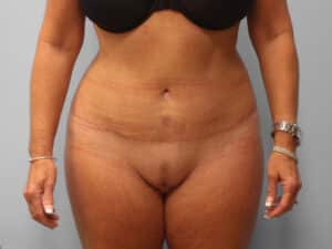After Image: Abdominoplasty & Lipo – Dr. Tucker