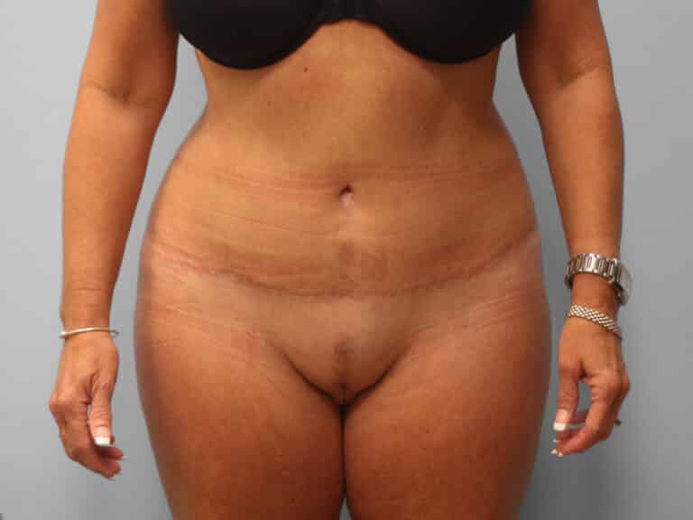 After Image: Abdominoplasty & Lipo – Dr. Tucker - front