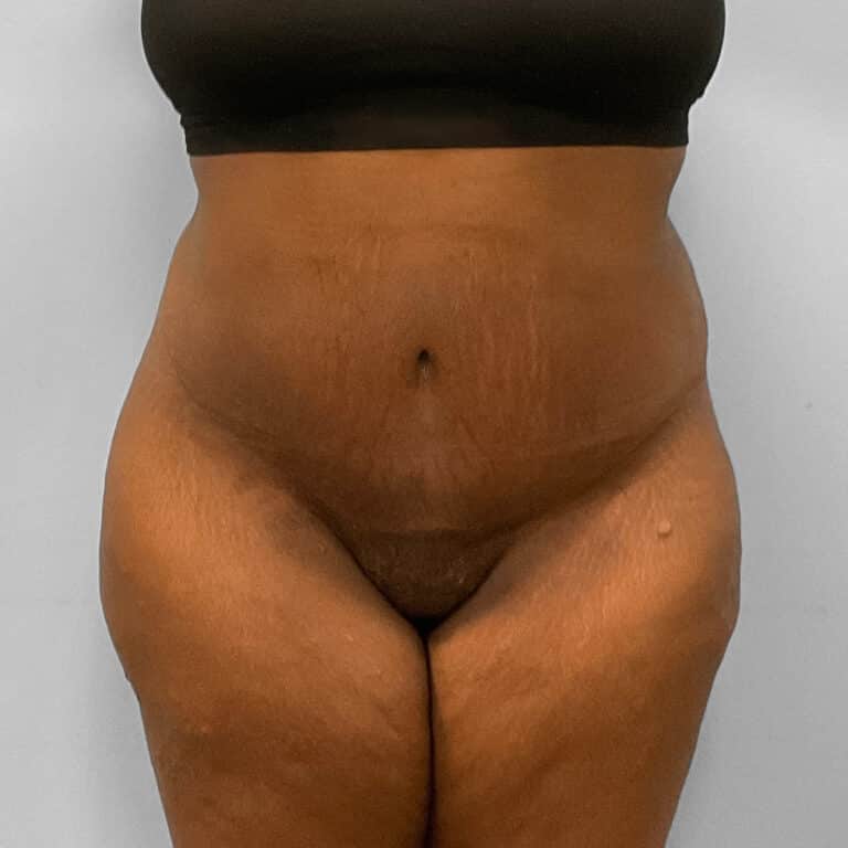 After Image: Abdominoplasty & Lipo – Dr. Tucker - front