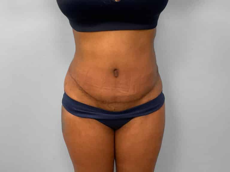 After Image: Tummy Tuck & Lipo – Dr. Tucker - front