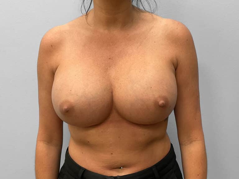 After Image: Breast Implant Exchange- Dr. Tucker - front