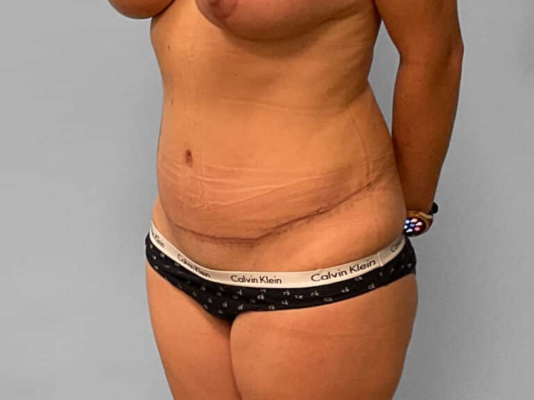 After Image: Tummy Tuck – Dr. Tucker - left-front-oblique
