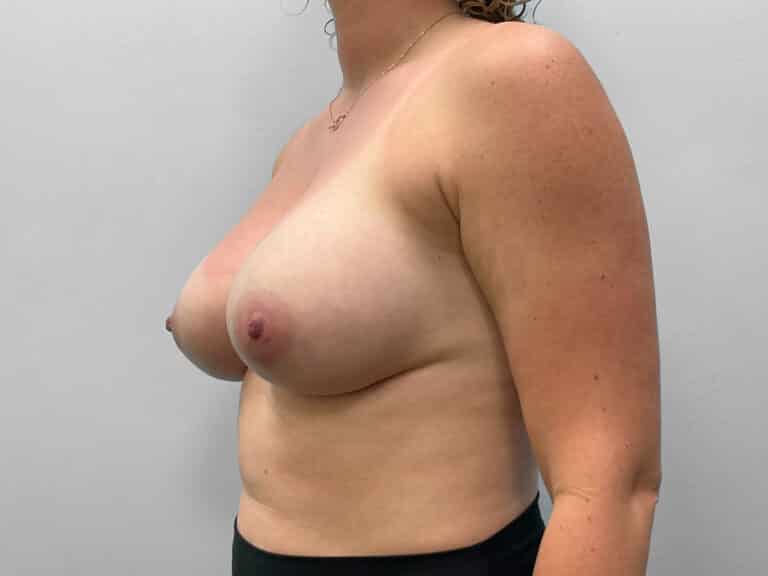 After Image: Breast Augmentation- Dr. Tucker - left-front-oblique
