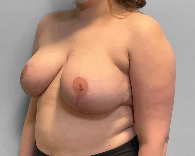 After Image: Breast Reduction – Dr. Tucker - left-front-oblique