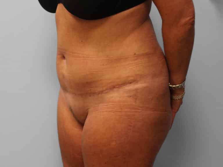 After Image: Abdominoplasty & Lipo – Dr. Tucker - left-front-oblique