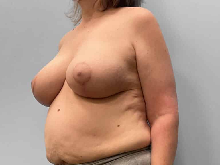 After Image: Breast Augmentation & Lift – Dr. Tucker - left-front-oblique
