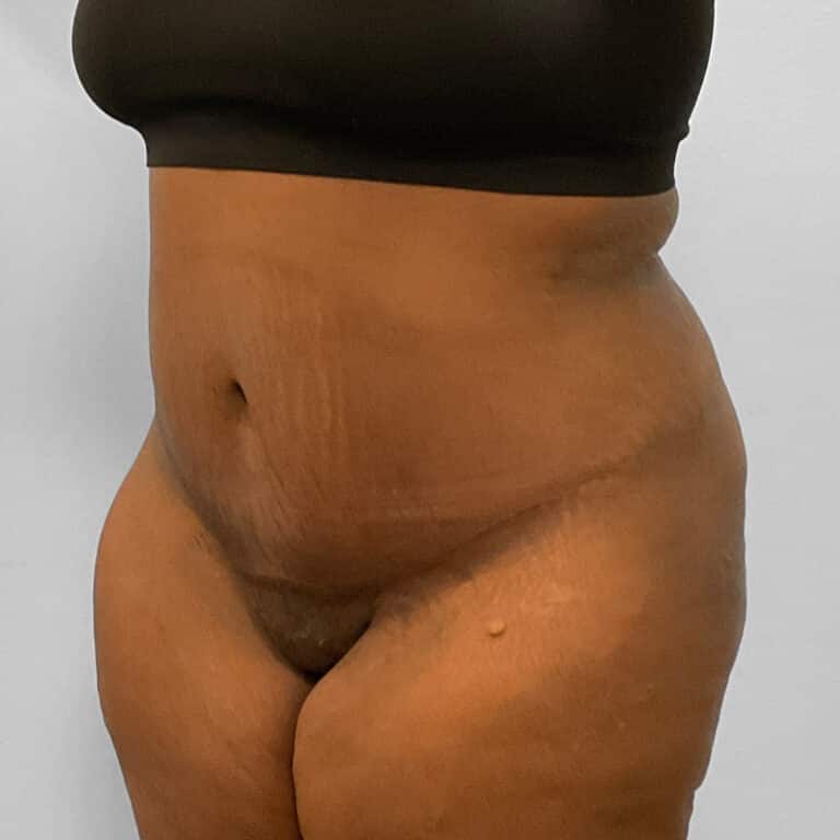 After Image: Abdominoplasty & Lipo – Dr. Tucker - left-front-oblique
