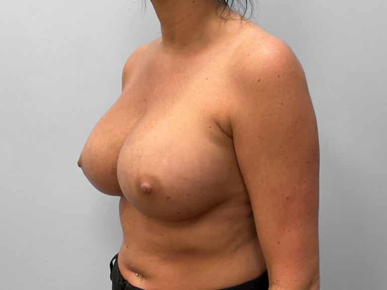 After Image: Breast Implant Exchange- Dr. Tucker - left-front-oblique