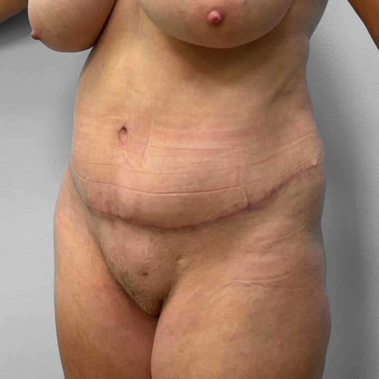 After Image: Tummy Tuck & Lipo – Dr. Tucker - left-front-oblique