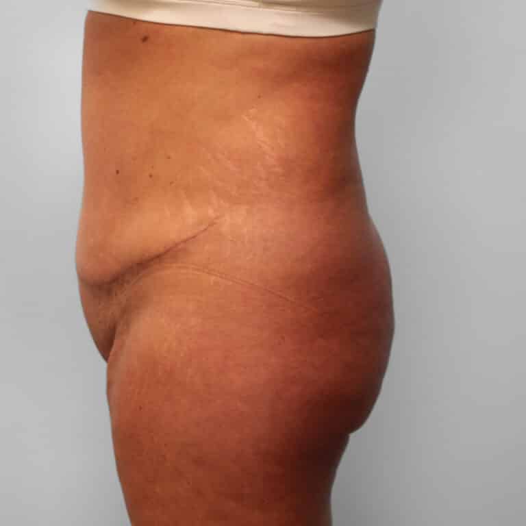 After Image: Tummy Tuck & Lipo – Dr. Tucker - left-side