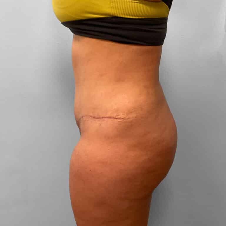 After Image: Abdominoplasty & Lipo – Dr. Tucker - left-side