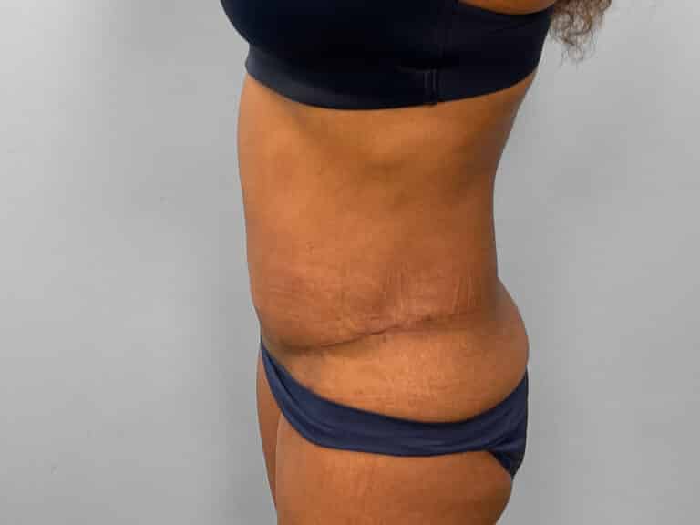 After Image: Tummy Tuck & Lipo – Dr. Tucker - left-side