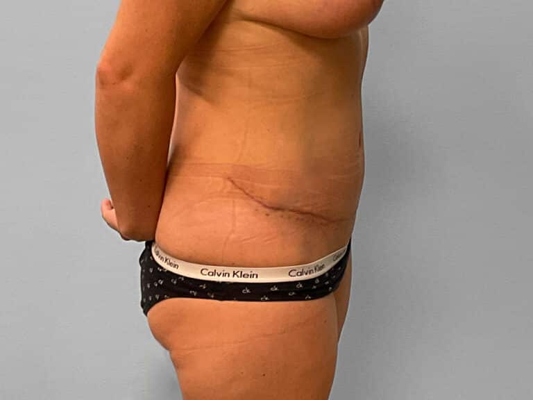 After Image: Tummy Tuck – Dr. Tucker - right-side