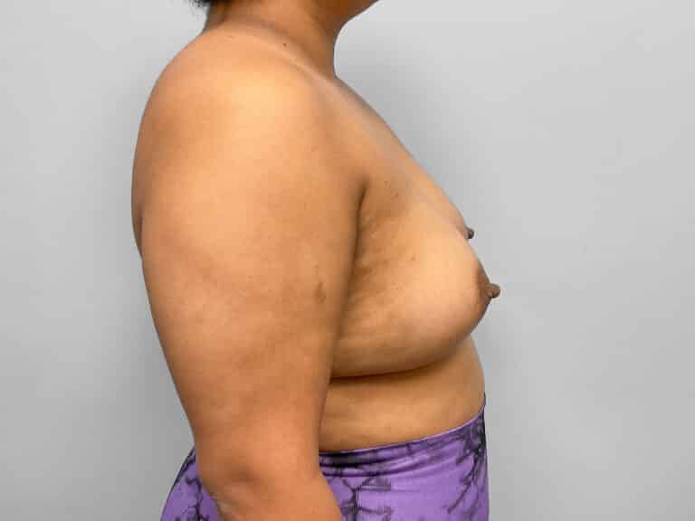 After Image: Breast Augmentation- Dr. Tucker - right-side