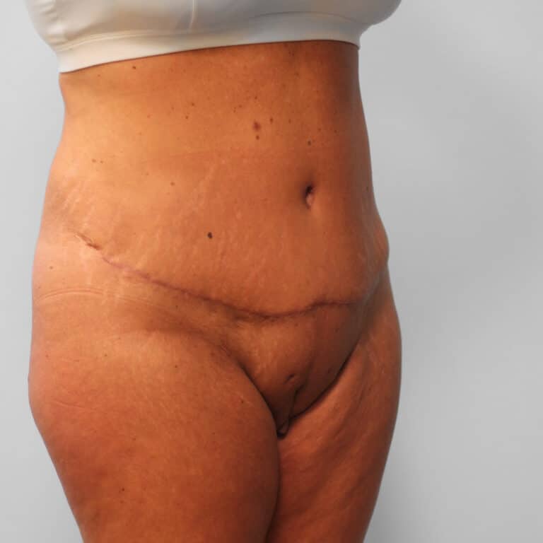 After Image: Tummy Tuck & Lipo – Dr. Tucker - right-front-oblique
