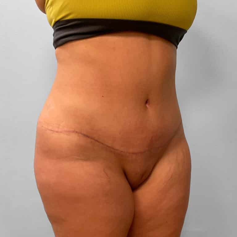 After Image: Abdominoplasty & Lipo – Dr. Tucker - right-front-oblique