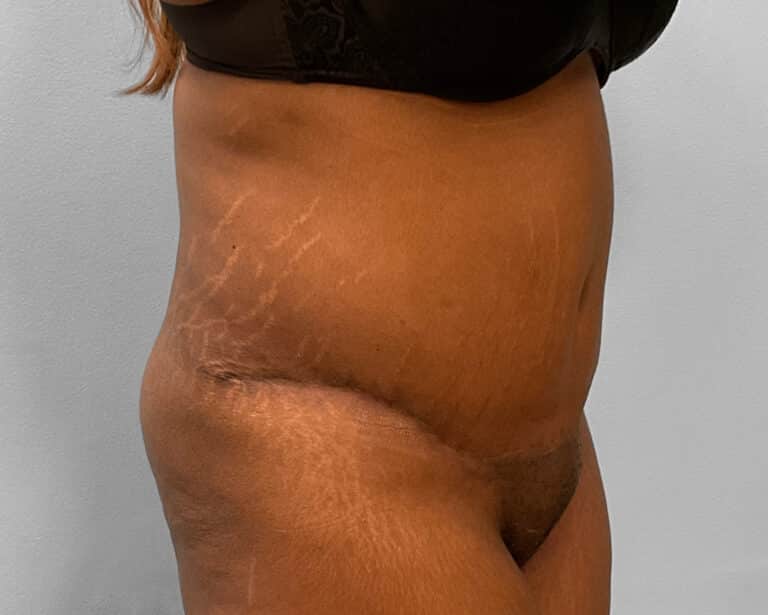 After Image: Tummy Tuck & Lipo – Dr. Tucker - right-front-oblique