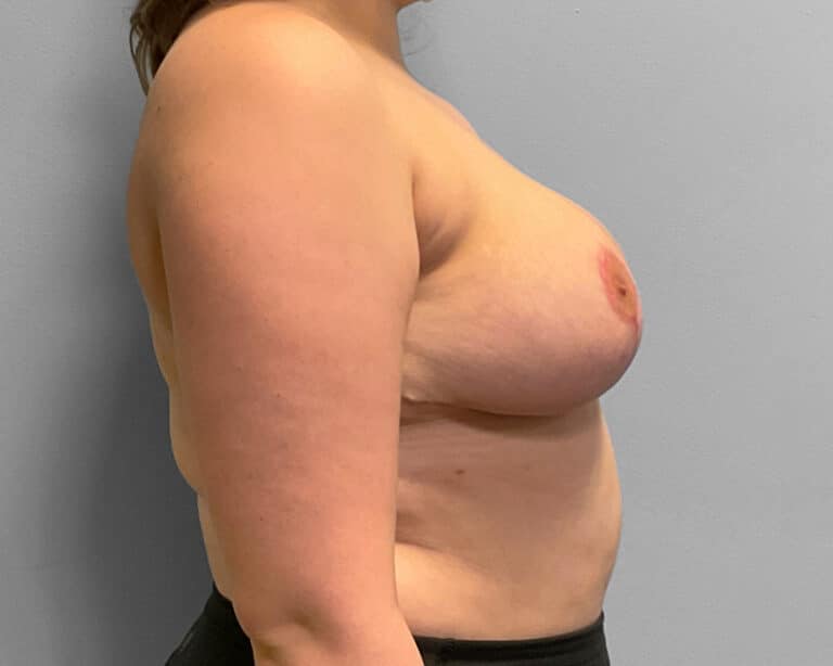 After Image: Breast Reduction – Dr. Tucker - left-side