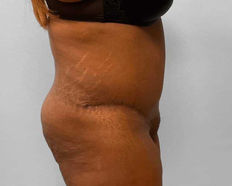 After Image: Tummy Tuck & Lipo – Dr. Tucker - right-side