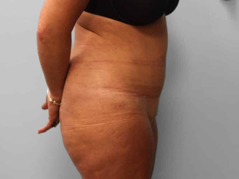 After Image: Abdominoplasty & Lipo – Dr. Tucker - right-side