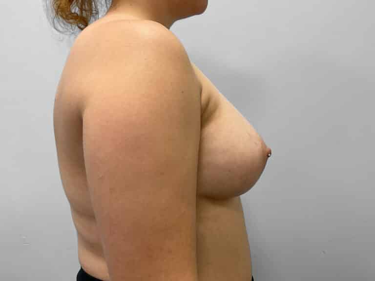 After Image: Breast Augmentation- Dr. Tucker - right-side