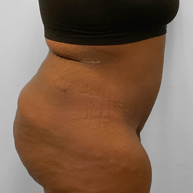 After Image: Abdominoplasty & Lipo – Dr. Tucker - right-side