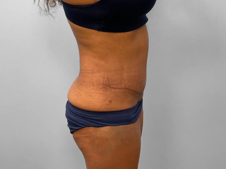 After Image: Tummy Tuck & Lipo – Dr. Tucker - right-side
