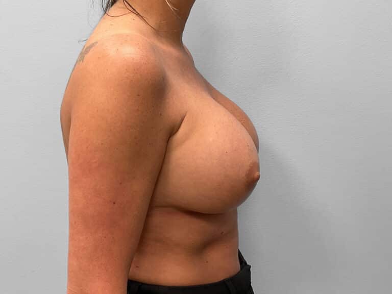 After Image: Breast Implant Exchange- Dr. Tucker - right-side