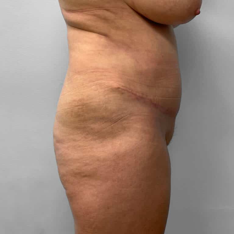 After Image: Tummy Tuck & Lipo – Dr. Tucker - right-side