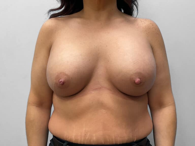 After Image: Breast Augmentation – Dr. Tucker - front