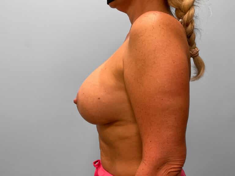 After Image: Breast Augmentation – Dr. Tucker - left-side
