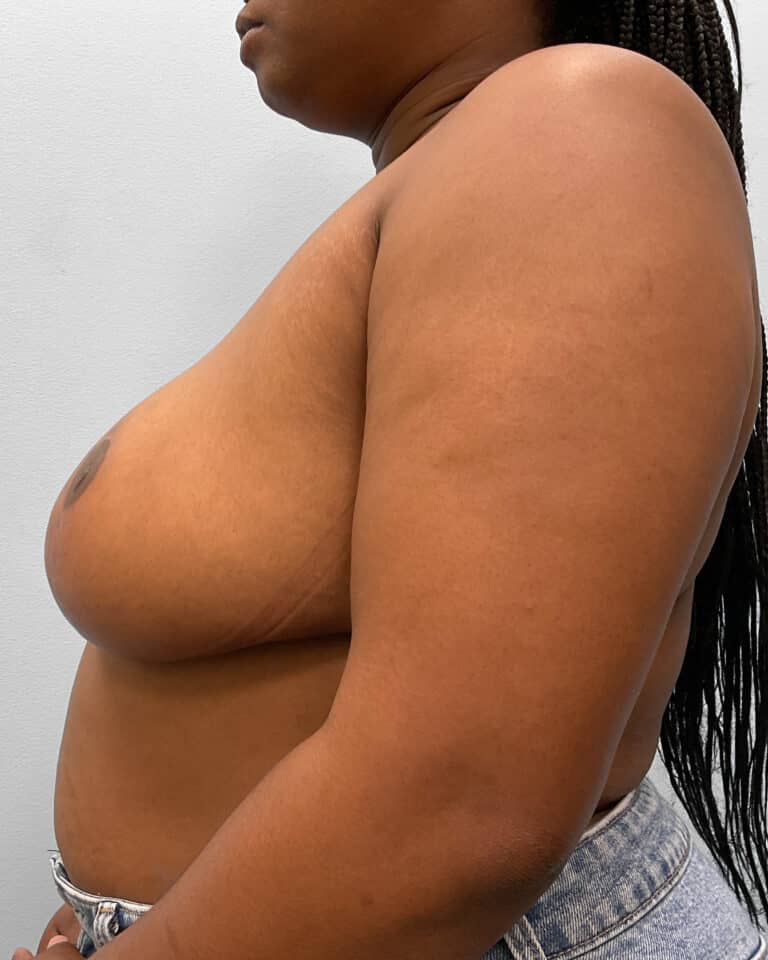 After Image: Breast Reduction- Dr. Tucker - left-side