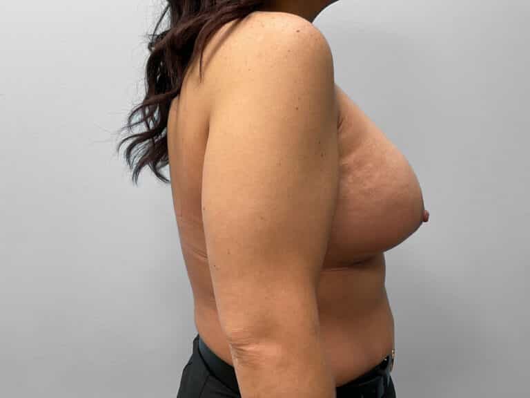 After Image: Breast Augmentation – Dr. Tucker - right-side