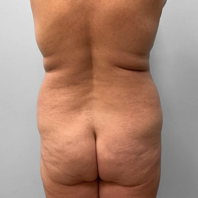 Before Image: Tummy Tuck & Lipo – Dr. Tucker - back