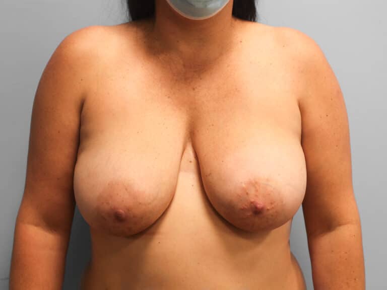 Before Image: Breast Lift & Reduction – Dr. Tucker - front