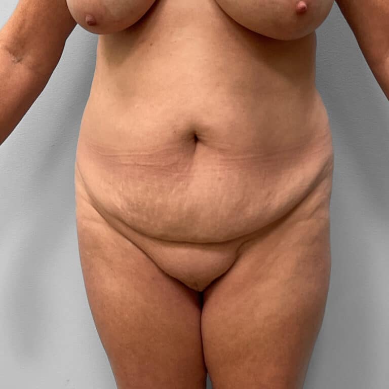 Before Image: Tummy Tuck & Lipo – Dr. Tucker - front