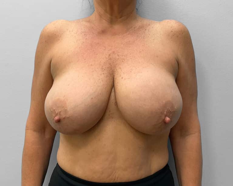 Before Image: Breast Implant Exchange- Dr. Tucker - front