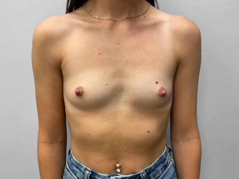 Before Image: Breast Augmentation- Dr. Tucker - front
