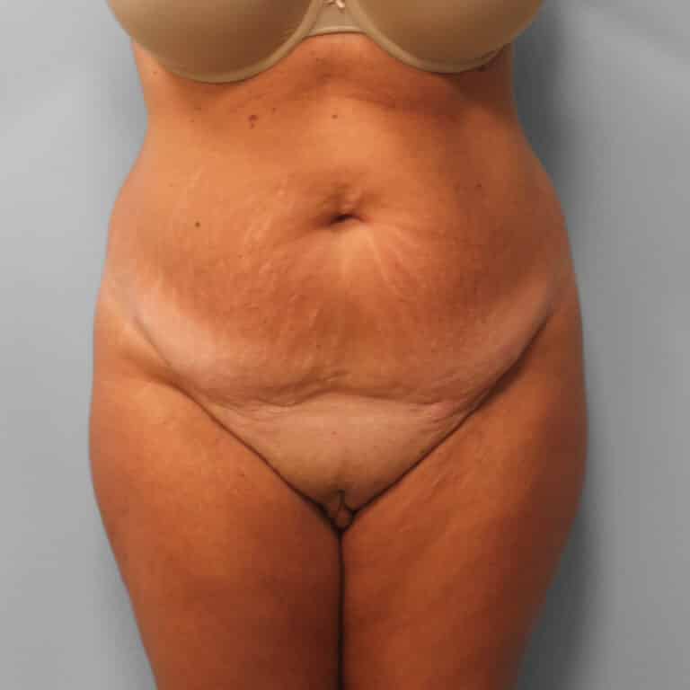 Before Image: Tummy Tuck & Lipo – Dr. Tucker - front