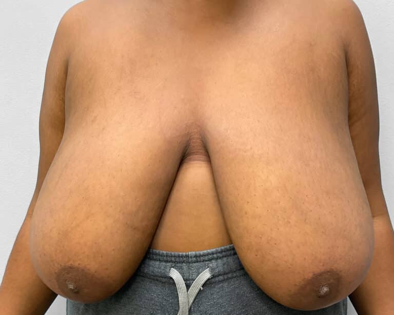 Before Image: Breast Reduction- Dr. Tucker - front