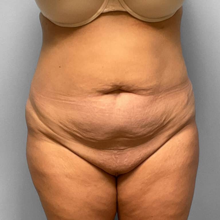 Before Image: Abdominoplasty & Lipo – Dr. Tucker - front