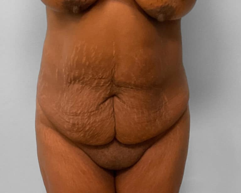 Before Image: Tummy Tuck & Lipo – Dr. Tucker - front