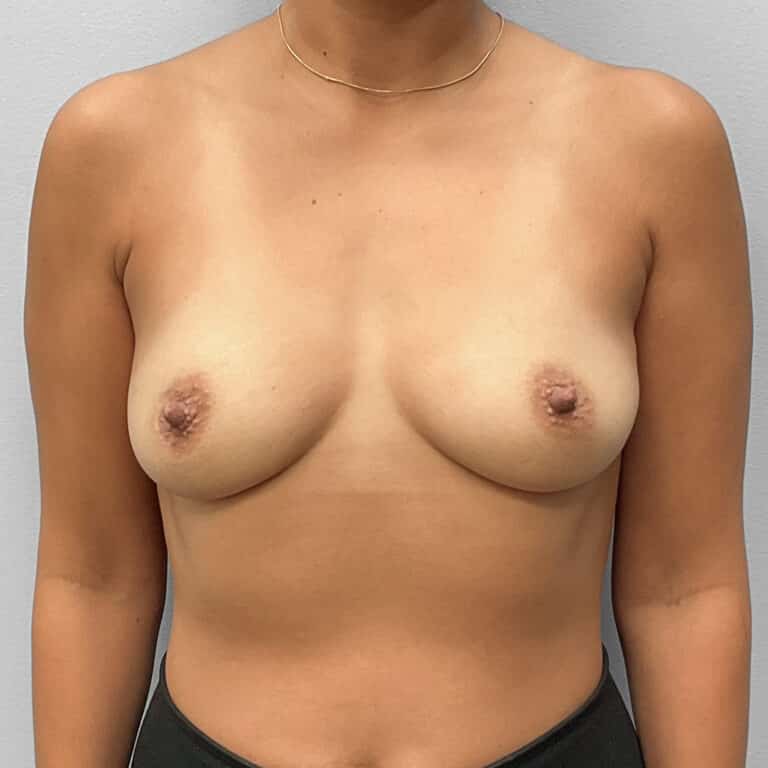 Before Image: Breast Augmentation- Dr. Tucker - front