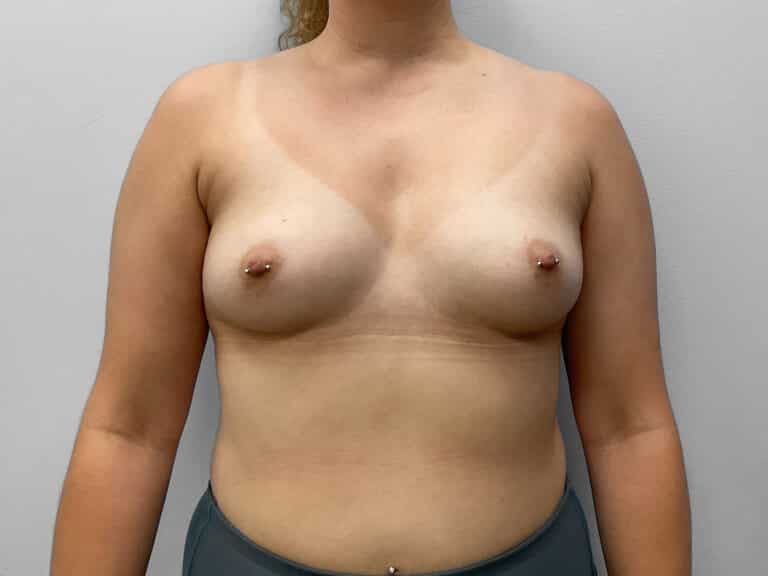Before Image: Breast Augmentation- Dr. Tucker - front