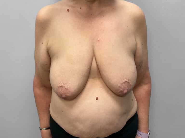 Before Image: Breast Augmentation & Lift – Dr. Tucker - front
