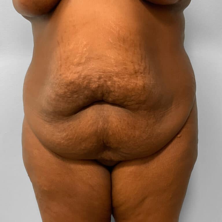 Before Image: Abdominoplasty & Lipo – Dr. Tucker - front