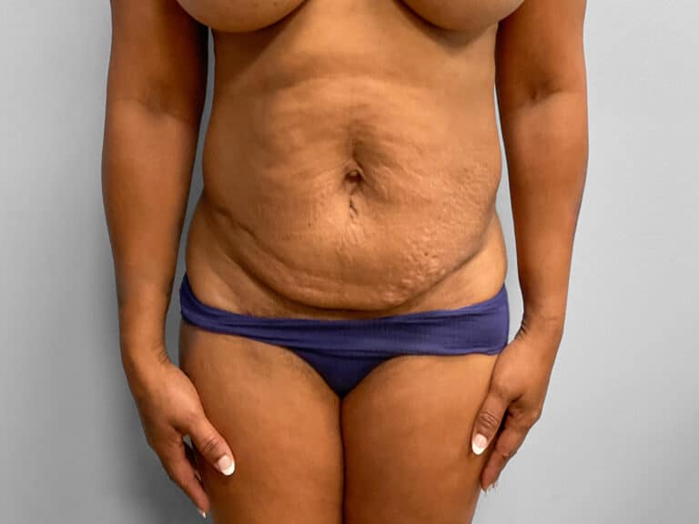 Before Image: Tummy Tuck & Lipo – Dr. Tucker - front