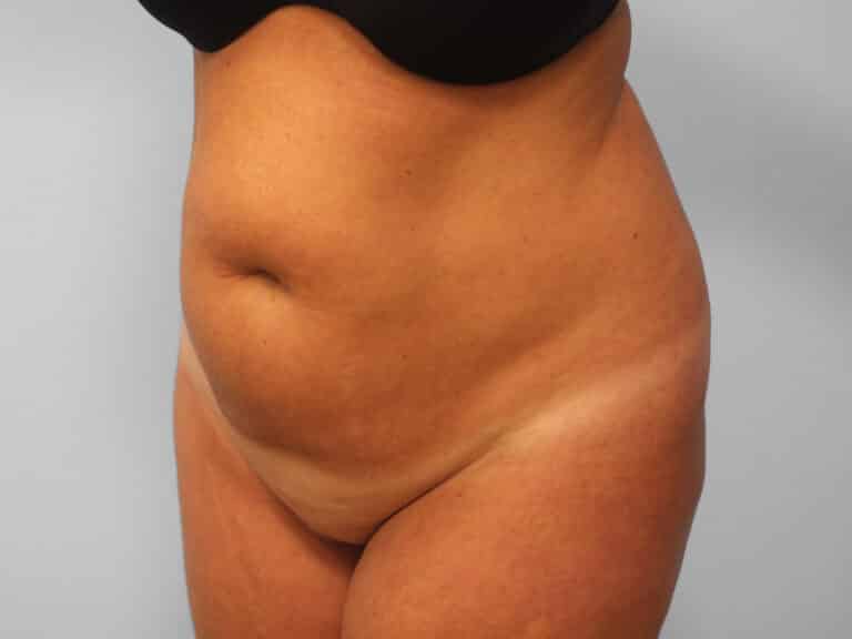 Before Image: Abdominoplasty & Lipo – Dr. Tucker - left-front-oblique