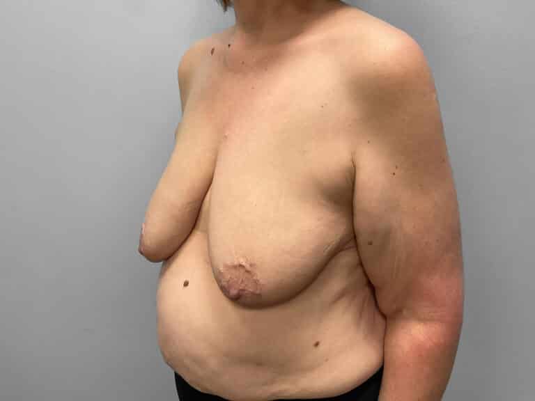 Before Image: Breast Augmentation & Lift – Dr. Tucker - left-front-oblique